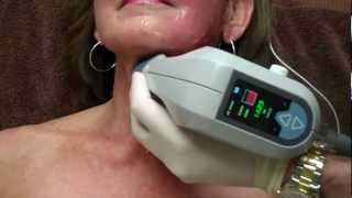 Exilis on Face amp Neck for Skin Tightening with Dr Seiler [upl. by Sedda]