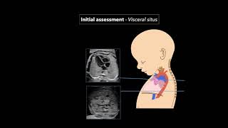 Topic 26 Intrapartum Fetal Surveillance [upl. by Meriel305]