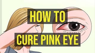 How To Cure Pink Eye Fast  5 Quick Ways [upl. by Pineda]