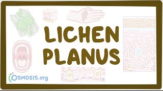 Lichen planus  causes symptoms diagnosis treatment pathology [upl. by Oirad998]