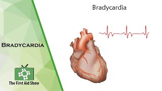 Bradycardia [upl. by Nelleus]