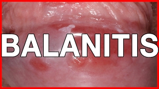 Balanitis Symptoms Causes Treatment and Prevention [upl. by Ailam]