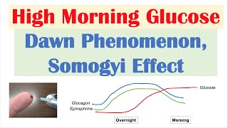 High Early Morning Glucose  Dawn Phenomenon amp Somogyi Effect [upl. by Aytac130]