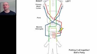 Hemiplegia 4 [upl. by Enilekaj]