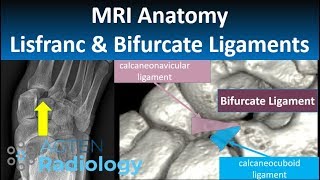 Lisfranc and Bifurcate Ligaments MRI Anatomy [upl. by Jona]