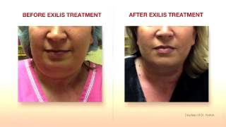 Exilis Elite Face Treatment Amara Clinic [upl. by Nyleuqcaj]