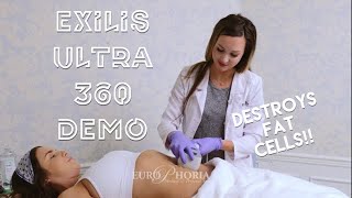 EXILIS ULTRA DEMONSTRATION BODY  Exilis Ultra 360 Experience at EuroPhoria [upl. by Norval]