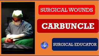 CARBUNCLE How To DIAGNOSE amp TREAT  SURGICAL INFECTIONS [upl. by Trev]