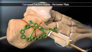 Calcaneal Fracture Perimeter Plate [upl. by Annawak185]