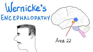 Wernickes Aphasia Fluent Aphasia  Neurology [upl. by Baelbeer]