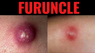 What is Furuncle Furuncle Boil DefinitionCauses Symptoms Risk Factors USMLE [upl. by Asp]