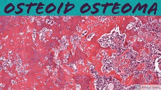 Osteoid Osteoma Bone Pathology Basics [upl. by Cam]