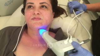 BTL Exilis Ultra  Neck Lift Skin Tightening  Cellulite Reduction  Beverly Hills [upl. by Ocirne]