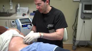 Exilis for Fat Reduction amp Skin Tightening on Stomach [upl. by Shaughn]