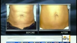 Exilis Body Contouring  Ultrasound Fat Reduction  Exilis Day [upl. by Raskin308]