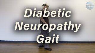 Diabetic Neuropathy Gait [upl. by Ozneral]