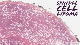 Spindle Cell Lipoma 5Minute Pathology Pearls [upl. by Sethrida178]